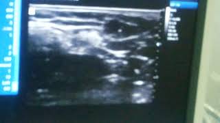 Ultrasound Guided Intercostobrachial Nerve Block [upl. by Bergh]