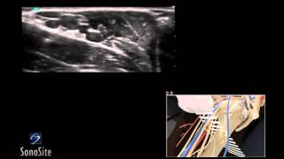 How To Ultrasound Guided Axillary Nerve Block 3D Video [upl. by Eylsel695]