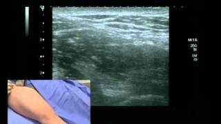 Femoral Nerve Block ultrasound guided [upl. by Pauletta]