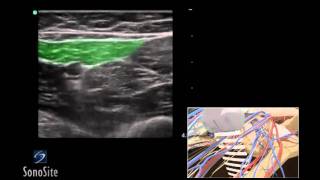 How To Ultrasound Guided Saphenous Nerve Block 3D Video [upl. by Akenal]