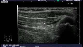 Ultrasound guided IlioinguinalIliohypogastric nerve block [upl. by Sandberg]