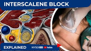 NYSORA Regional Anesthesia Interscalene Block [upl. by Moon]