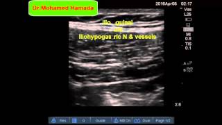 Ultrasound Guided IlioinguinalIliohypogastric Nerve Block [upl. by Everara]