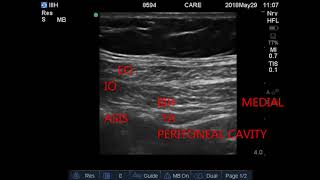 usg GUIDED Ilioinguinal amp IliohypogastricIIIH nerve block [upl. by Leviram]