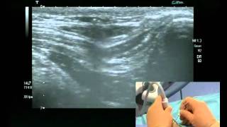 Ilioinguinal Block ultrasound guided [upl. by Manvell]