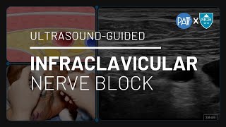 Infraclavicular Nerve Block  UltrasoundGuided Demonstration [upl. by Tedi843]