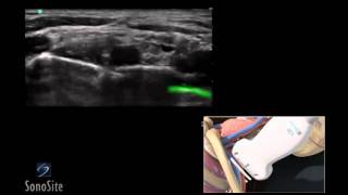 How To Ultrasound Guided Interscalene Nerve Block 3D Video [upl. by Ahgiel]